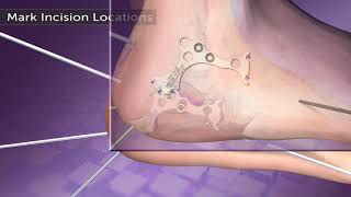 Calcaneal Fracture Animation [upl. by Noived]