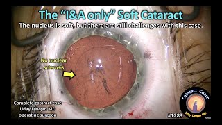 CataractCoach 1283 the IampA only soft cataract [upl. by Maletta517]