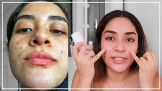 PRIMER MES CON TRATAMIENTO ANTI ACNÉ Con Epiduo Gel  Gabcamva [upl. by Gabriellia]