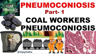 PNEUMOCONIOSIS Part 1 Pathogenesis Coal workers pneumoconiosis [upl. by Anividul]