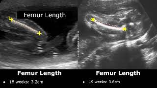 Femur Length Ultrasound Normal Values  Femoral Length Measurements  Fetal Biometric Parameters USG [upl. by Nehtanhoj472]