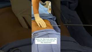 SmartLipo Procedure on Patients Abdomen [upl. by Naillij691]