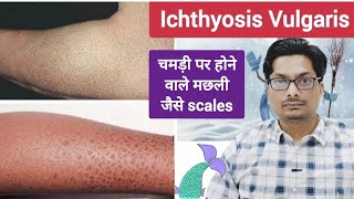 चमड़ी पर होने वाले मछली जैसे scales  Ichthyosis Vulgaris  Itchy dry fish like skin ichthyosis [upl. by Nerrat]