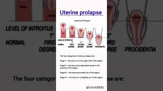 Uterine prolapse  viralshorts uterus uterineprolapse obgy [upl. by Jaban]