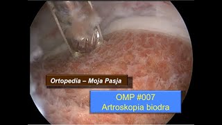 Artroskopia biodra  artroskop przygotowanie procedura i powikłania  OMP 007 [upl. by Gilford]