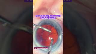 How to do bimanual irrigation aspiration during phacoemulsification cataract surgery in one minute [upl. by Eical]