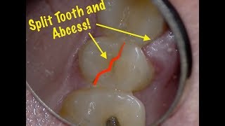 Split Tooth Root Fracture  Diagnosis including transillumination this time [upl. by Yael]