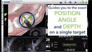 Introduction to the XGuide Dynamic 3D Navigation System [upl. by Acsisnarf]