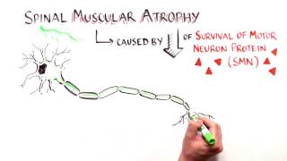 Cut and Paste Treating Spinal Muscular Atrophy with Nusinersen [upl. by Sllew288]