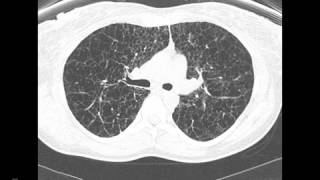 HighResultion CT of the Chest CaseReview Webinar [upl. by Nine]