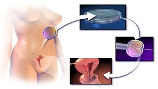 How to Get Pregnant with ICSI Intracytoplasmic Sperm Injection Procedure Step by Step Video IVF [upl. by Avi]