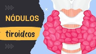 NÓDULOS TIROIDEOS CAUSAS SÍNTOMAS TRATAMIENTO BOLITAS EN EL CUELLO [upl. by Hunsinger]