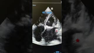 Left atrial thrombus 4C view echo cardiology mitral thrombosis medicine [upl. by Assirrem511]