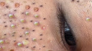 Relax Every Day With Loan Nguyen Spa  Acne Treatment Pimple Popping 44 [upl. by Naitsirk]