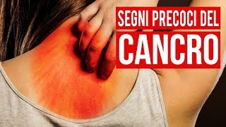 10 Segni Precoci Del Cancro Che La Maggior Parte Delle Persone Ignora [upl. by Katherina]