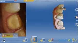 CEREC Omnicam Anterior Application  cadstartv [upl. by Komarek]