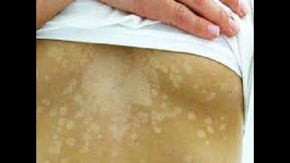 Tinea Versicolor Fungal infection Sehua का सही इलाज। Dr Sandesh Gupta Dermatologist [upl. by Ydde552]