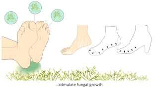 Onychomycosis  What is it and how is it treated [upl. by Enilarak]