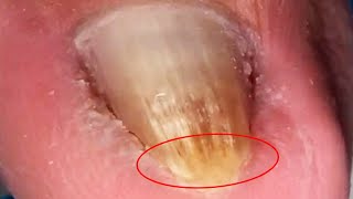 Triangular onychomycosis trimming remove bad nails on both sides【Crazy pedicure room】 [upl. by Aihgn]