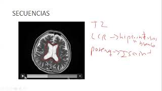 RMN CEREBRAL FUNDAMENTOS [upl. by Aicssej]