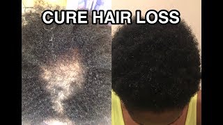 HOW TO CURE HAIR LOSS AND ALOPECIA FAST [upl. by Jorin]