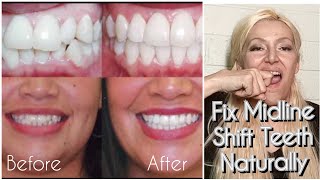 How To Fix Midline Deviation Teeth Canted Midline Dental Midline Shift Naturally Without Braces [upl. by Naimed]