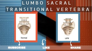 LUMBOSACRAL TRANSITIONAL VERTEBRAE  LSTV  LUMBARIZATION  SACRALIZATION  BERTOLOTTI SYNDROME [upl. by Dulce]