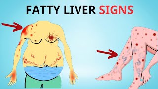 A Silent Threat 8 Signs That Could Indicate Fatty Liver Disease  Healthy Care [upl. by Herzen105]