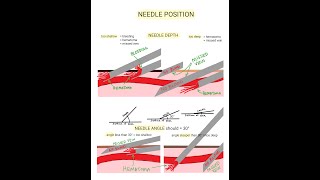 Venipuncture  How to Position a Needle [upl. by Annor226]