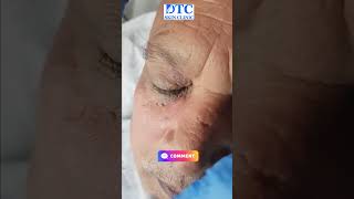 Watch Our Skin Tag Removal Procedure at DTC Skin Clinic [upl. by Peony]