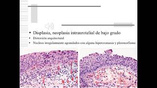 PATOLOGIA TUMORAL DE PELVIS RENAL Y VIAS URINARIAS [upl. by Cloris]