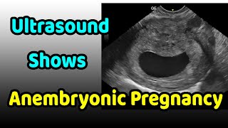 Ultrasound Shows Anembryonic Pregnancy [upl. by Gaal]