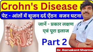 Crohns Disease A Comprehensive Guide to Diagnosis and Managementdrramakantsharma7 [upl. by Idet]