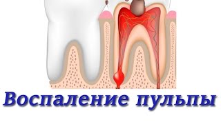 Лечение зубов Воспаление пульпы Методы лечения Терапевтическая стоматология [upl. by Vanhomrigh232]