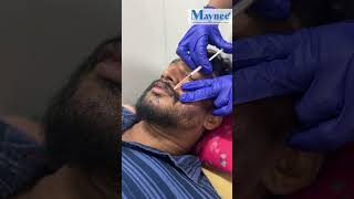 Actor Sathya  Beard Growth Journey  Beard Transplantation and PRP  Maynee Cosmetology Clinic [upl. by Spiro]