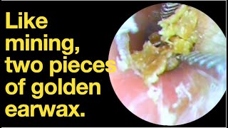 Like mining two pieces of golden earwaxear wax removal  ear cleaning  ASMR  relaxation  relax [upl. by Eiramlehcar]