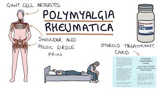 Polymyalgia Rheumatica Visual Explanation for Students [upl. by Marijane94]