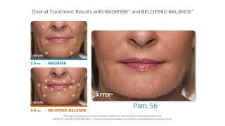 Radiesse and Belotero  Facial Fillers [upl. by Kameko357]