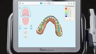 iTero® Scanner Tutorial Occlusogram [upl. by Oitaroh]