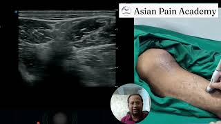 Mastering Sonoanatomy Gluteal Region Live Demo by Dr Chinmoy Roy  Asian Pain Academy [upl. by Esil348]