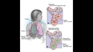 Pneumonia and Tuberculosis explained in UrduHindi [upl. by Vera]