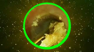 Earwax and clean the ear part 9 [upl. by Maitund]