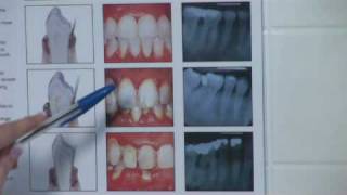 Teeth Whitening  Identifying Moderate Periodontitis [upl. by Nawyt819]