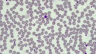 WBC Differential WBCPLT Estimate RBC Morphology [upl. by Aseela]