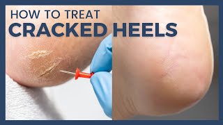 How To Treat Cracked Heels  Reduce Callus and Fissures [upl. by Lopes]