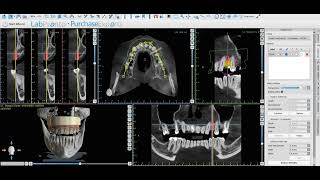 Design Implant Guides in Blue Sky Bio amp 3Matic – No Exports Needed part 1 [upl. by Augustus]