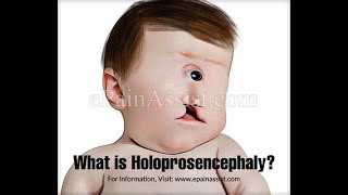 Embryonic Basis for holoProsencephaly Anencephaly Meroanencephaly and hydrocephalus [upl. by Primrosa]