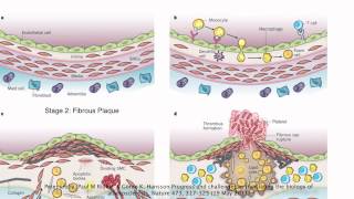 Stages of Atherosclerosis [upl. by Eimorej]