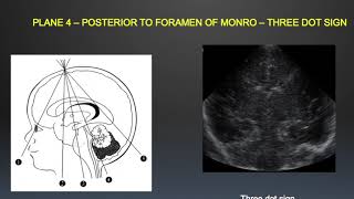 TMT Neurosono by Dr Mrudula Bapat  Basic Anatomy amp Scanning Technique [upl. by Salis]