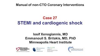 Case 27 PCI Manual STEMI and shock [upl. by Thomas716]